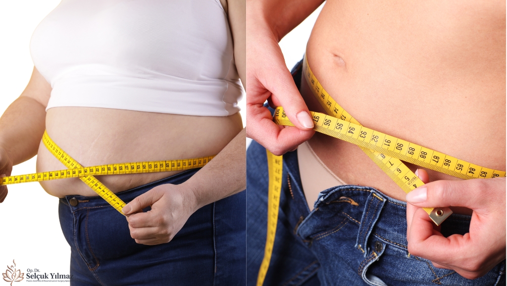 Benefits of liposuction in Turkey