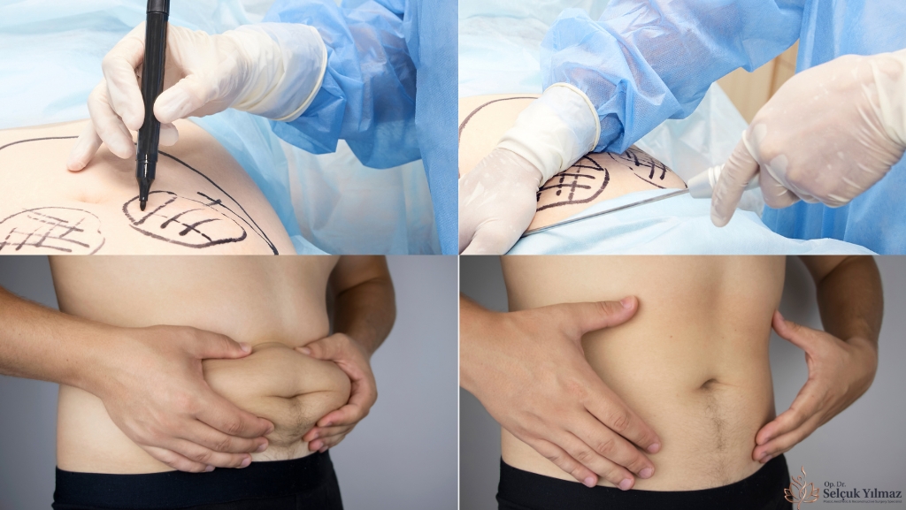 How is performed liposuction procedure?